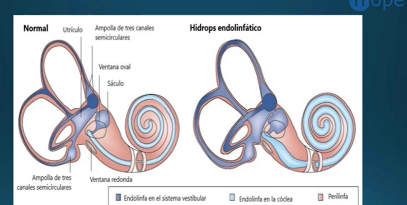 Lee más sobre el artículo Enfermedad de Menière: Cuando el equilibrio y la audición se convierten en un reto diario